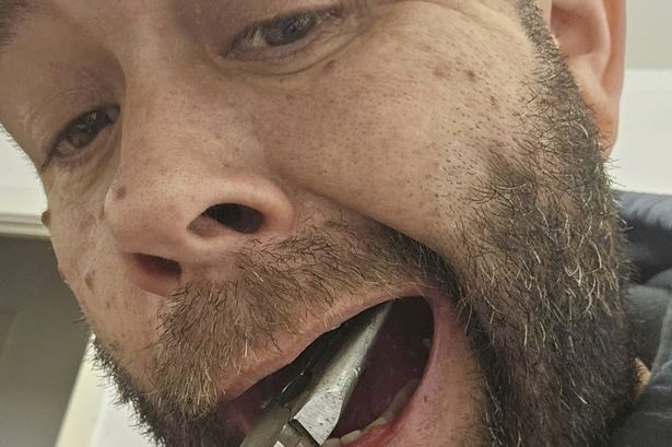 ‘I couldn’t get an NHS dentist so used pliers to save myself £90’