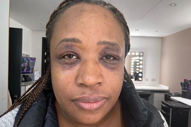 ITV Loose Women’s Charlene White’s health condition which leaves her ‘unable to open her eyes’