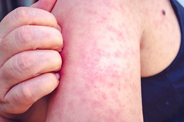 Measles outbreak in Lancashire confirmed as parents urged to get kids vaccinated