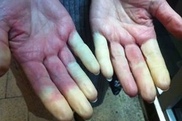 ‘Cold hands’ condition which changes the colour of your fingers and toes