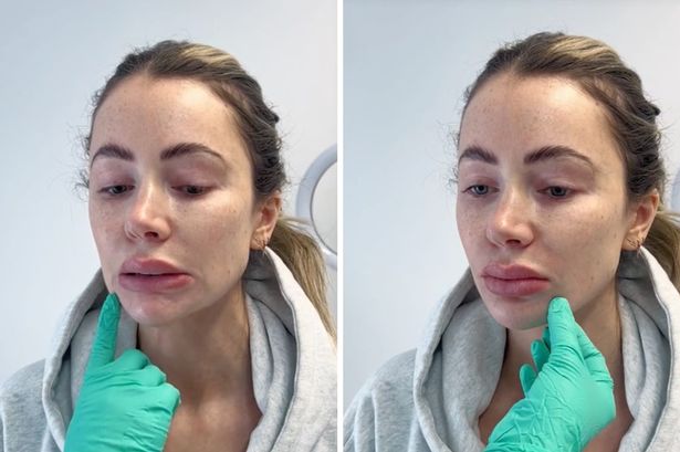 ‘I tried Olivia Attwood’s pre-wedding jowl-busting treatment and the results are amazing’