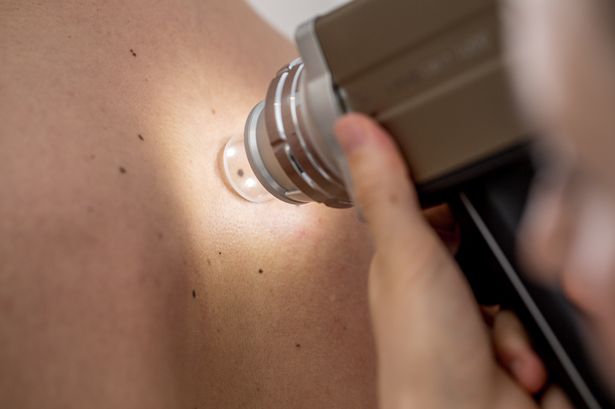 ‘This new skin scanner is the future of mole mapping, and I was one of the first to try it’