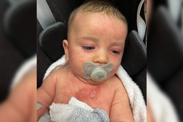 Mum ‘on verge of complete breakdown’ finds high street cure for son’s agonising eczema and shares tips with struggling parents