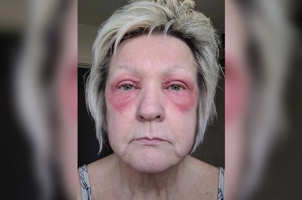 Mum felt like monster after waking with red rings around her eyes