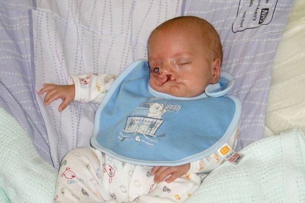 Mum told she was ‘cruel’ for having  son after he was born with severe cleft lip