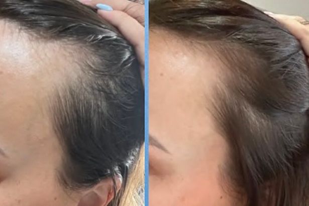 Shoppers love new hair growth serum that gives ‘double the amount of hair’ in 5 weeks