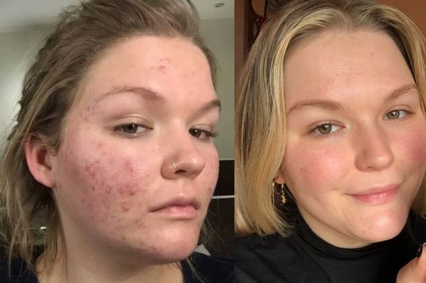 ‘Life-changing’ serum that clears up acne and scarring has shoppers noticing ‘a huge difference in weeks’