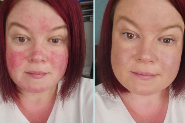 ‘Best anti-redness cream ever’ has shoppers skipping foundation and gives ‘such a confidence boost’