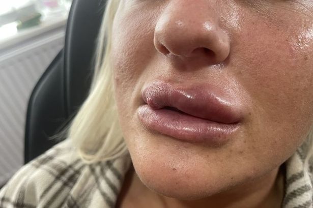 Mum so ‘addicted’ to face fillers she’s left looking ‘deformed’ – as lips swelled into ‘beak’ and began to rot