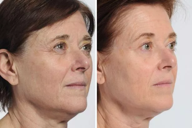 Shoppers say this laser facial gadget ‘gives better results than injections’ – and you can save 30%