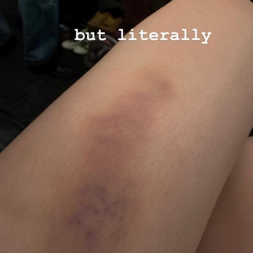 Billie Eilish displays large bruise after falling over at concert