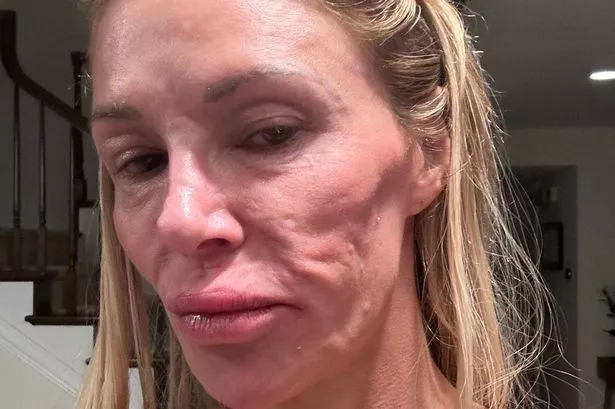 Real Housewives star Brandi Granville reveals she’s dissolved all her face fillers amid ‘parasite’ crisis