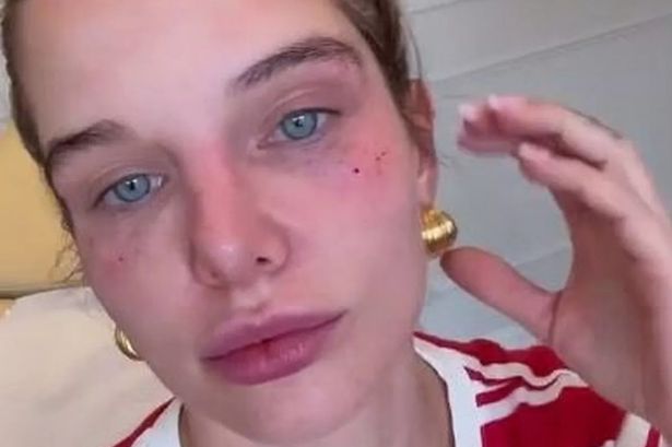 Helen Flanagan says ‘be worth it when I look 24’ as she addresses ‘black eyes’