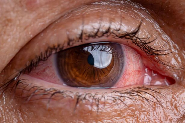 ‘Hay fever causing unbearably itchy eyes? You might need this Godsend’