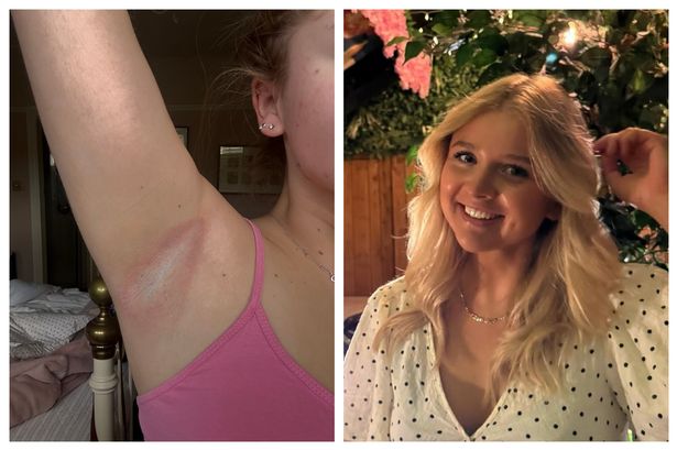 ‘I was left in agony after Mitchum deodorant gave me ‘burning’ armpit rash’