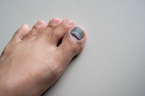Seven weird reactions you get to exercise – from bleeding to black nails