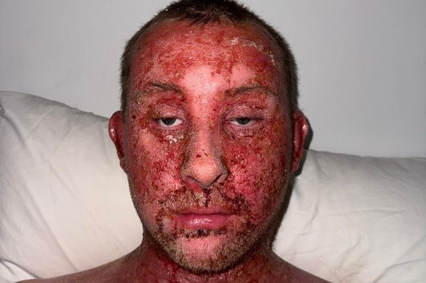 ‘Using eczema cream left me in agony – I couldn’t get out of bed for weeks’