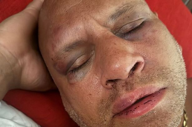 Preston dad feared for his life after brutal holiday attack in Tenerife bar