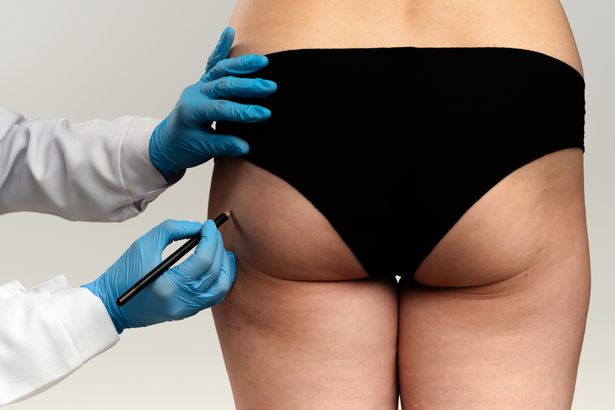Butt lifts set to be banned over ‘serious threat to patient safety’