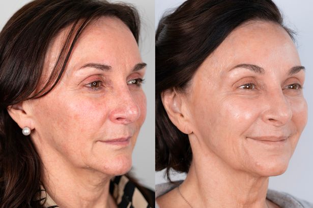 Strictly judge Shirley Ballas, 66, ‘looks better than 10 years ago’ after £4.5k non-surgical facelift